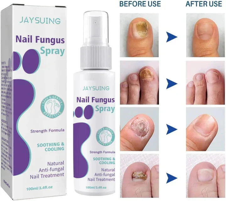 ðŸ¦¶ Medinail Advanced Antifungal Foot & Nail Spray â€“ Soothing & Cooling Treatment for Athleteâ€™s Foot, Nail Fungus, and Odor Control â€“ 100ml